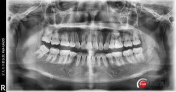 拔牙锯齿视频成人,成人生涯中的口腔健康守护者